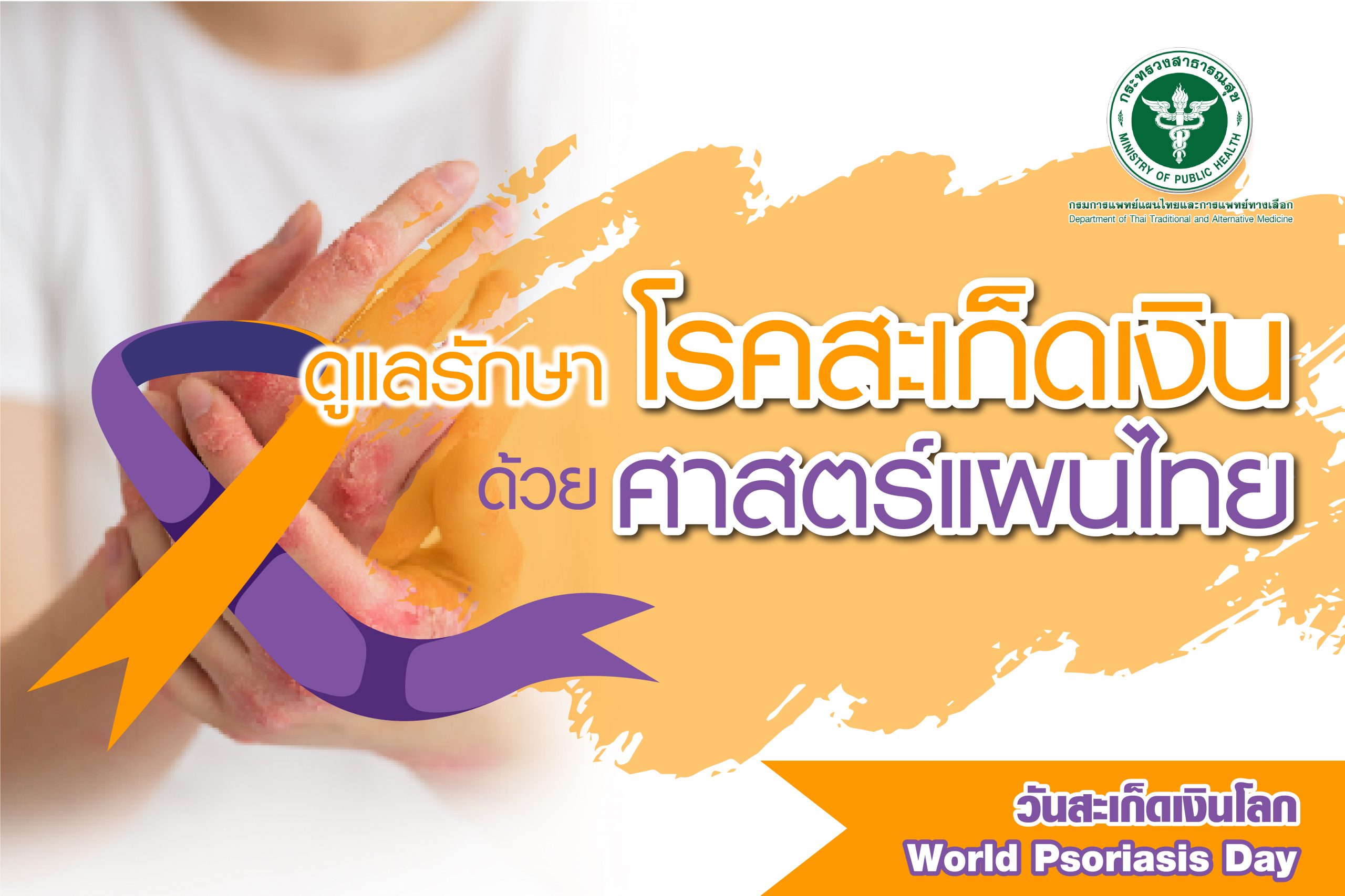 ดูแลโรคสเก็ดเงิน ด้วยศาสตร์แผนไทย